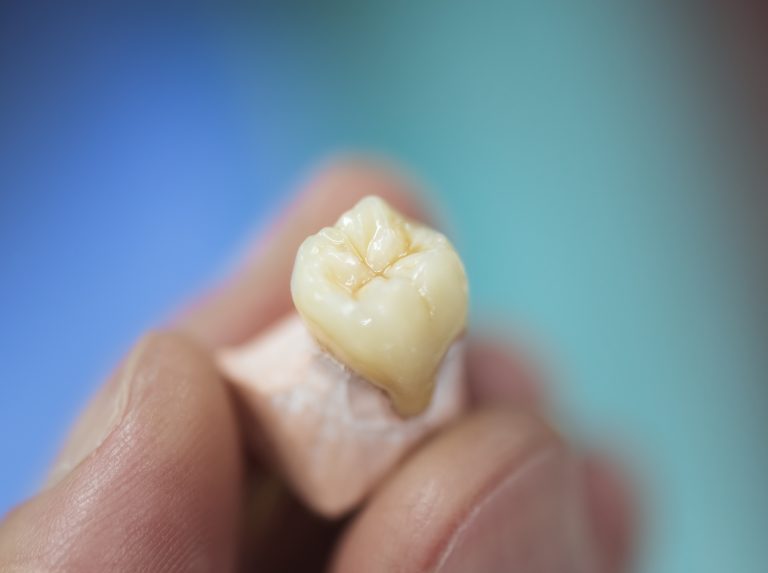 Artificial tooth held by a dental prosthesis specialist.