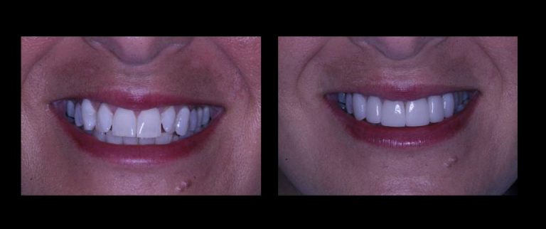 Porcelain Veneers