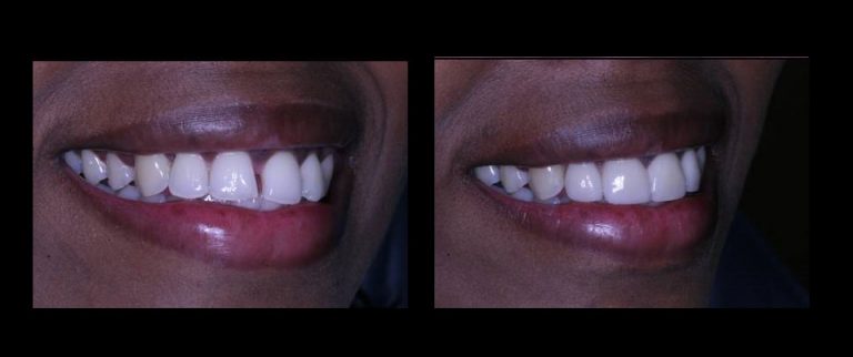 Porcelain Veneers
