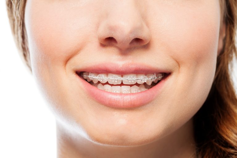 A Woman With Clear Braces Smiling