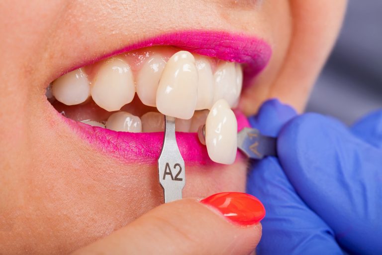 A Dental Shade Determination Under Progress