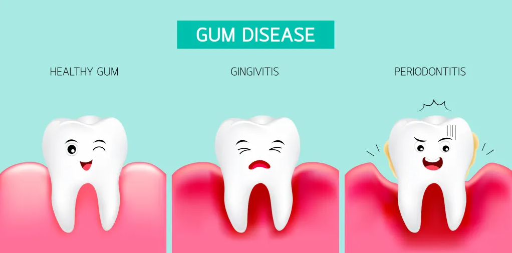 - VISIT A DENTIST REGULARLY TO ELIMINATE PLAQUE BUILDUP AND HELP PREVENT GINGIVAL DISEASE
