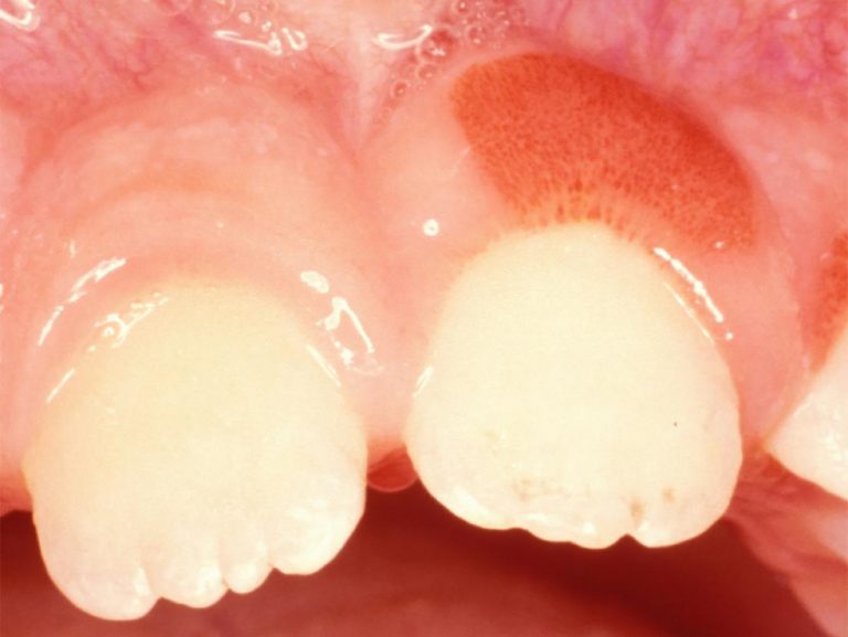 Four Signs That Indicate Tooth Cavity