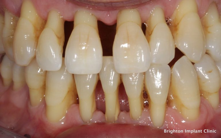 What Is Gingival How To Treat Gingival Disease
