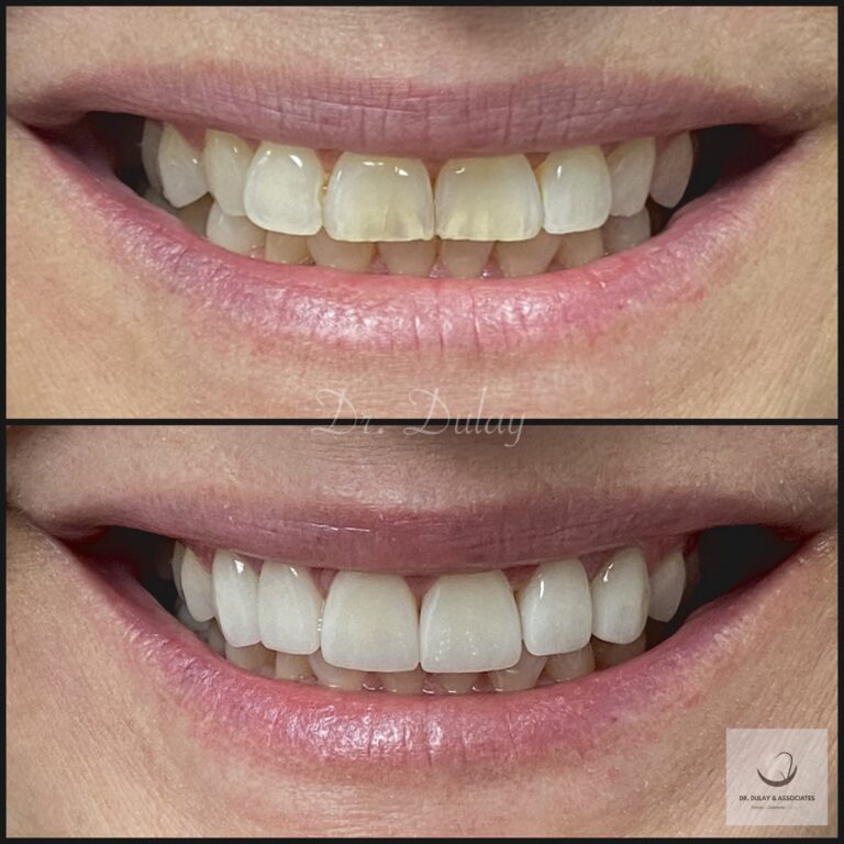 Porcelain Veneers