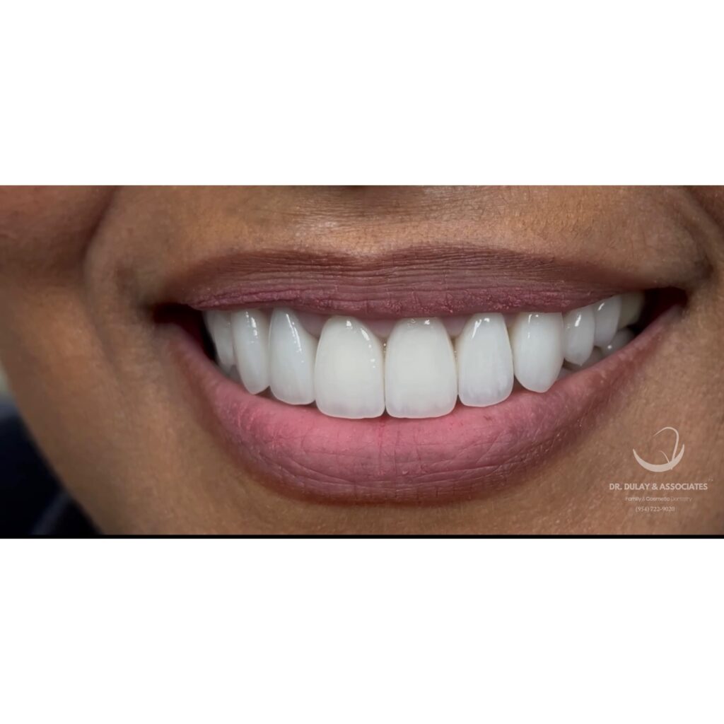 Porcelain veneers -smile created by Dr. Dulay in Tamarac, FL.