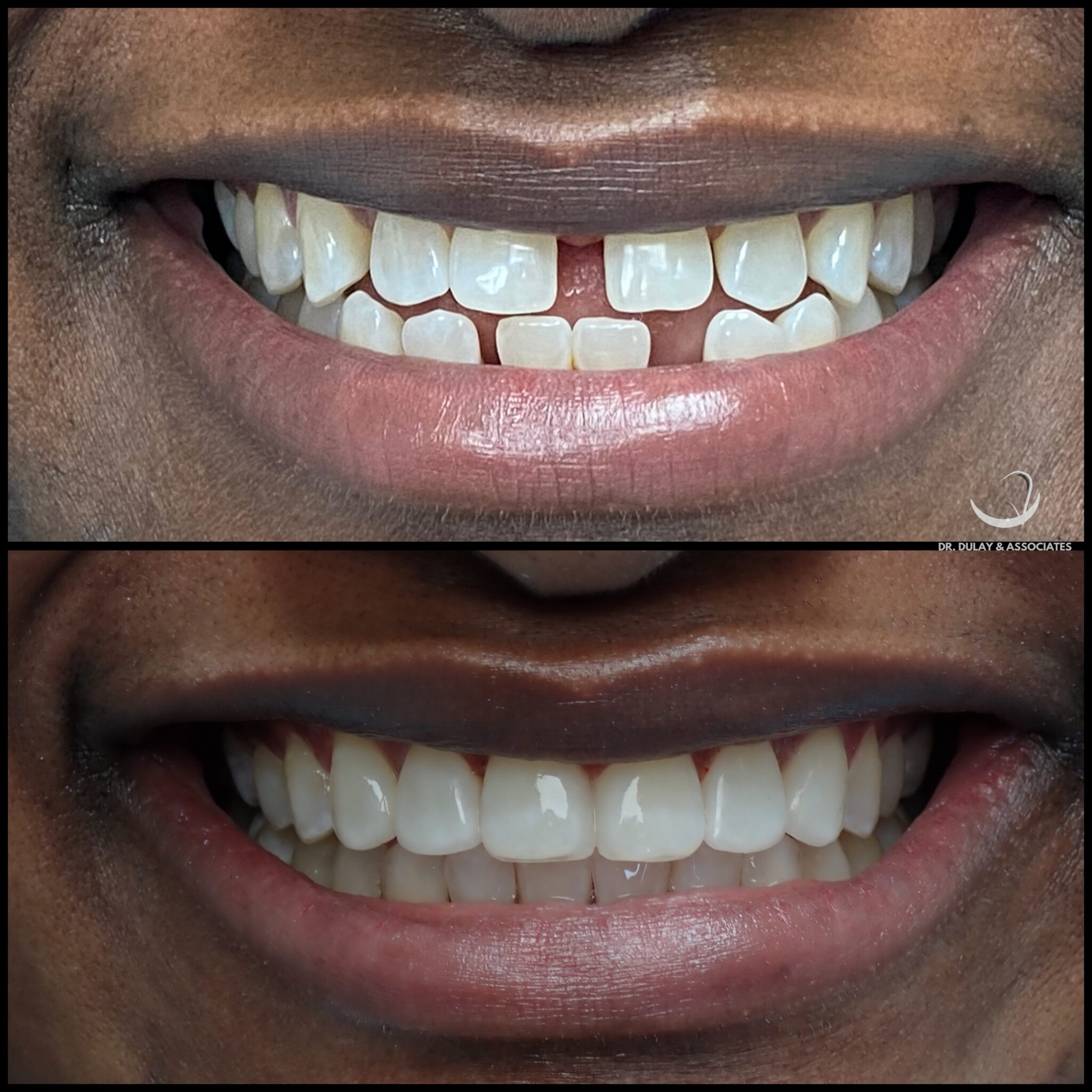 Before and after composite veneers — Dr. Dulay & Associates, Tamarac, FL