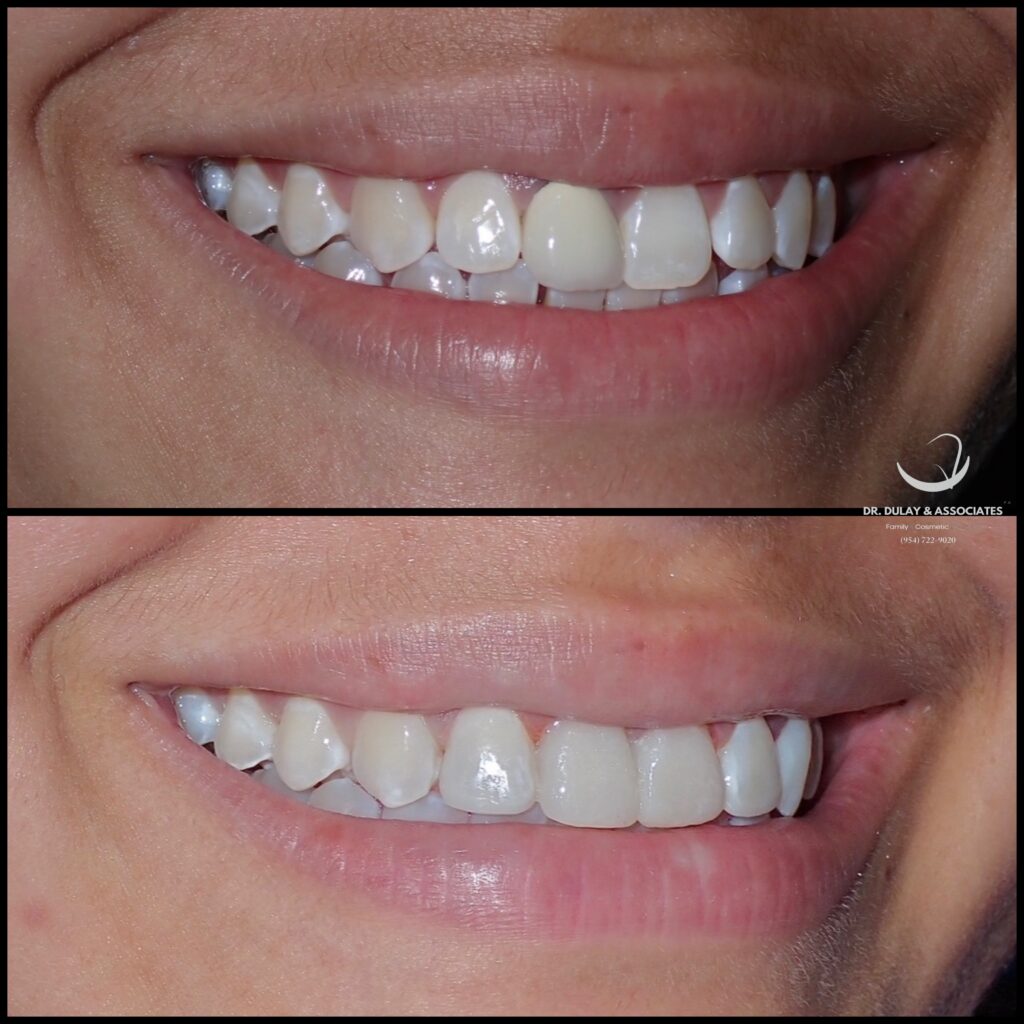 Smile makeover by Dr. Dulay- Tamarac, FL.