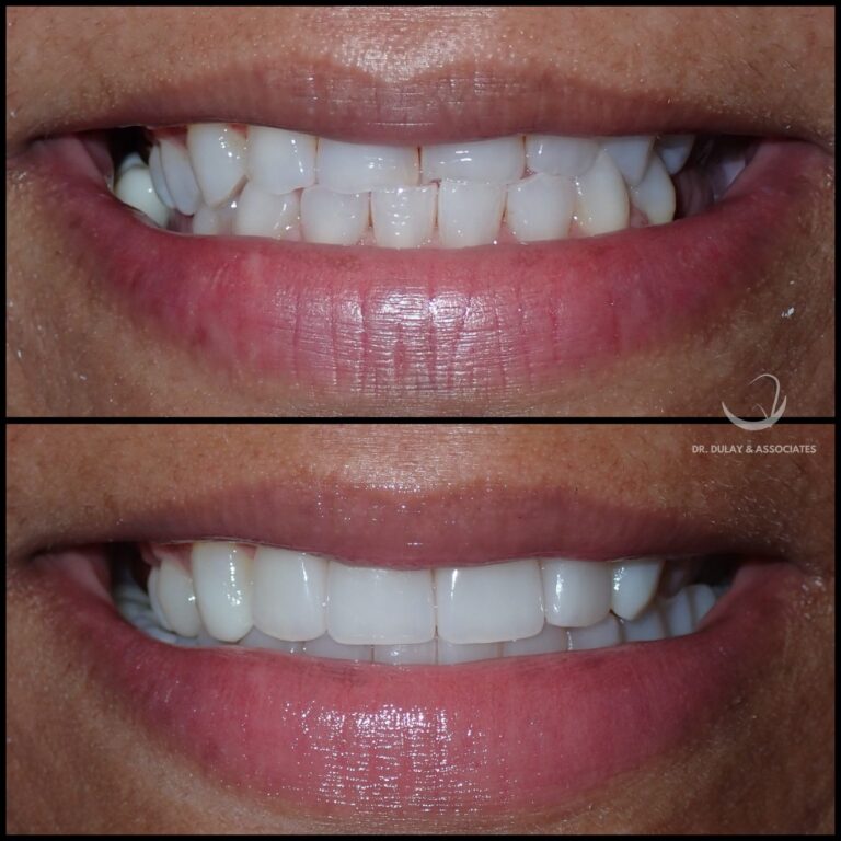 Smile makeover before and after at a Tamarac cosmetic dentist: worn upper front teeth showing only a narrow band of tooth with the lower teeth dominating, then a restored smile with full upper incisors and a corrected smile line.