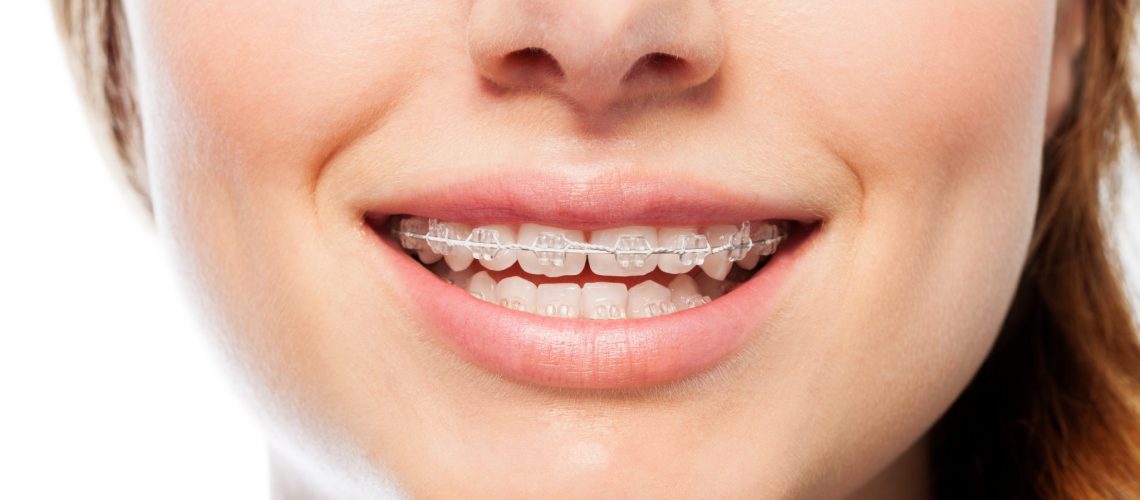 Close-up picture of happy woman's smile with orthodontic clear braces